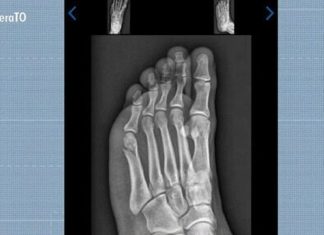 Candidato faz teste físico da PM com fratura no pé e consegue aprovação: ‘Pensei que não ia conseguir’