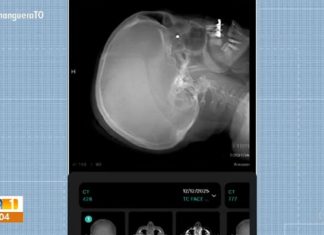 Mulher atingida por tiro em barraca de parque está com chumbinho alojado no olho