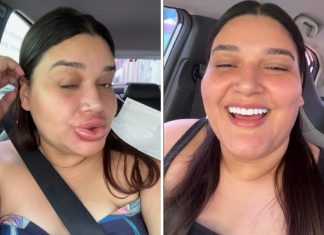 Após maquiadora ficar com lábios gigantes, médica fala sobre cuidados com procedimentos estéticos